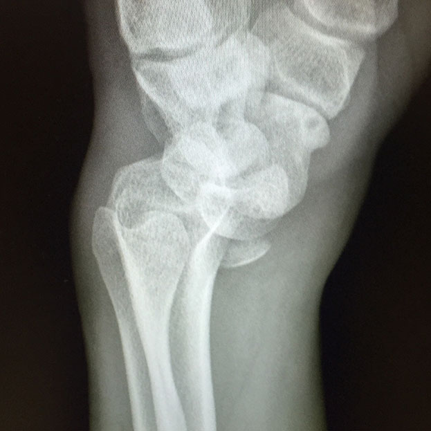 Radial-carpal dislocation. A lightning strike.