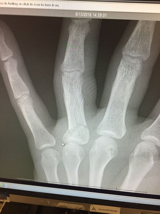 Badly broken left ring finger.