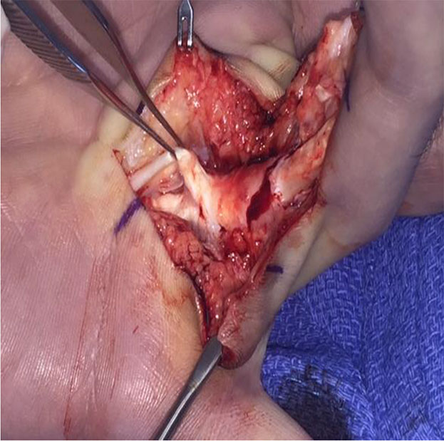 Tendon being pried off scar.